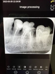 ENDODONCIA